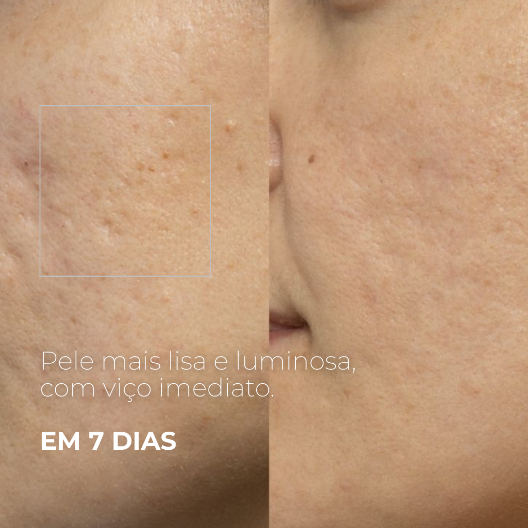 PICOTAGE – Peeling com Microspículas