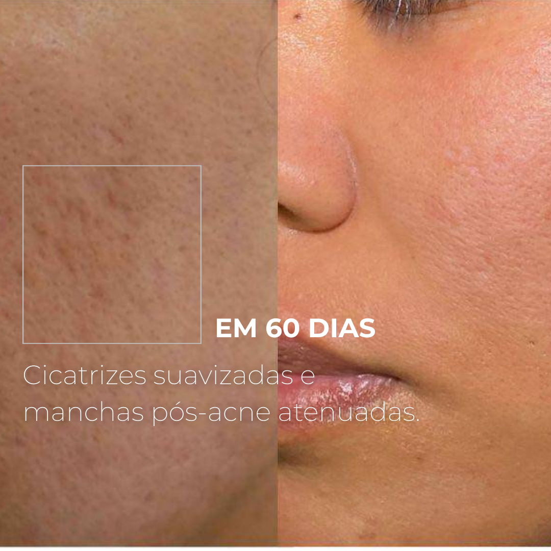 PICOTAGE – Peeling com Microspículas