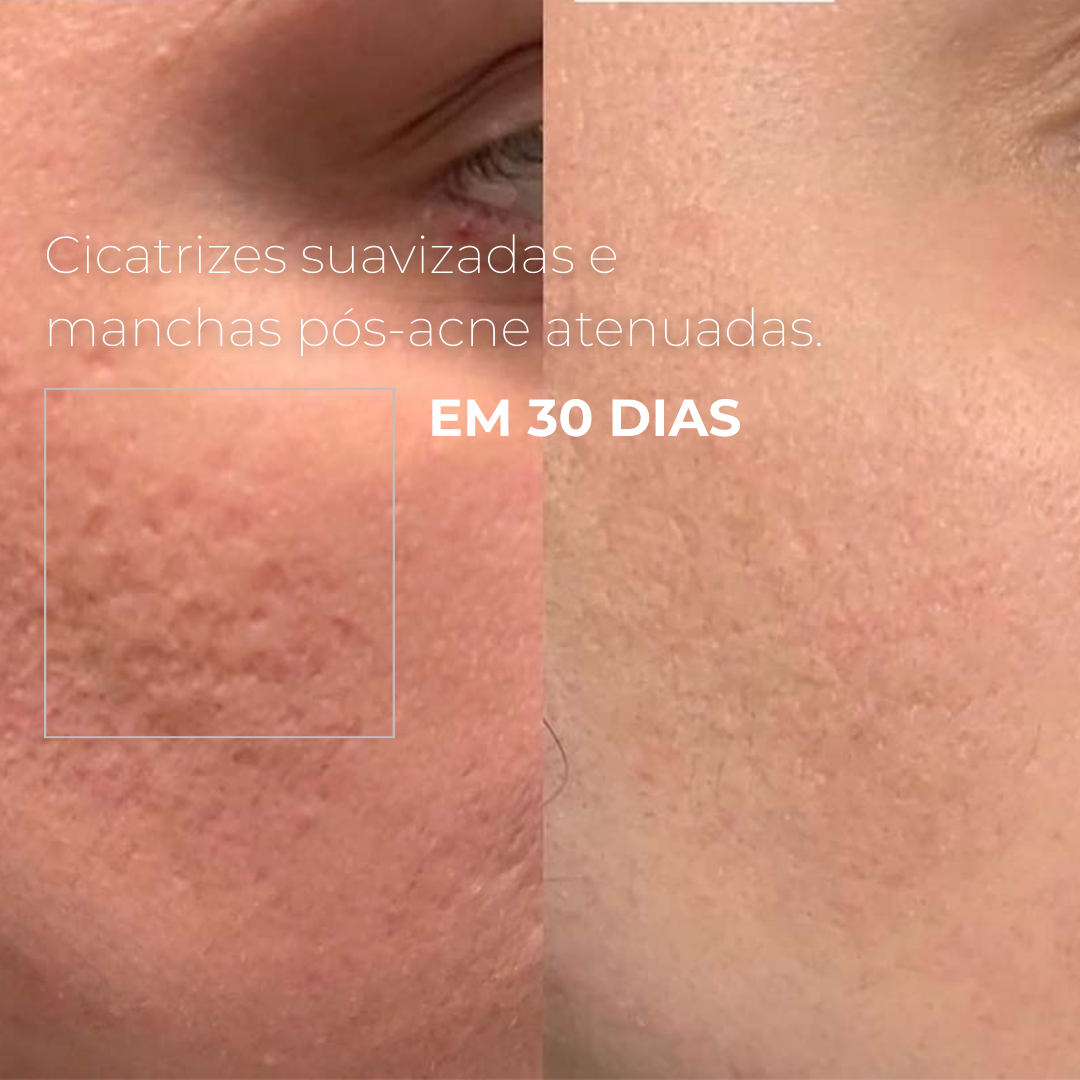PICOTAGE – Peeling com Microspículas