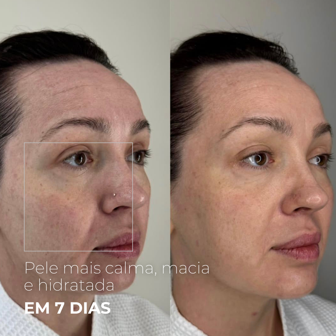 EXOMAGE — DNA ativador de juventude em booster de PDRN com Exossomos