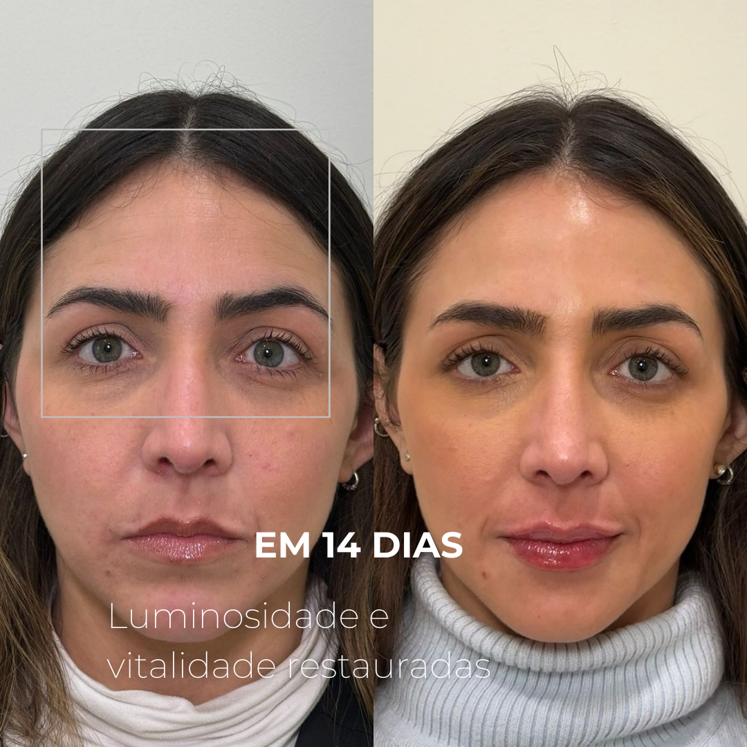 EXOMAGE — DNA ativador de juventude em booster de PDRN com Exossomos